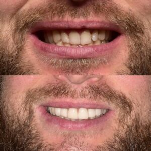 Szybkie schudnięcie bez ryzyka dla zdrowia – odkryj skuteczne sposoby na udaną metamorfozę